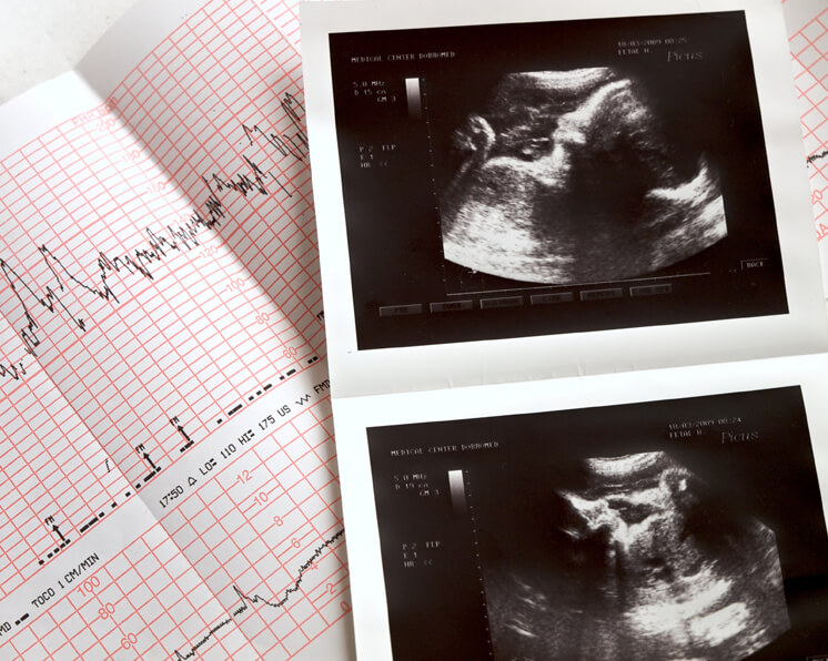 Eritoblastosis fetal